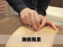 整骨院カイ 三宮(KAI)/鍼灸施術風景