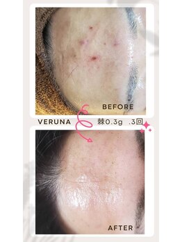 ココ 2号店(CoCo)/ニキビ改善