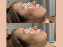 リタ 銀座(Rita)/水素パックシェービング☆1回