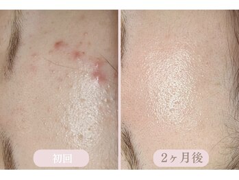 エピル(EPIL)/スキンケアセット症例