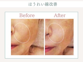 トータルビューティー ゆみえエステ(Total Beauty)/ハイパーナイフ フェイシャル