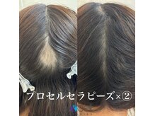 プロセルセラピーズ育毛促進／施術のみで頭皮のお悩み解消へ