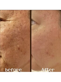 リリベル(LilyBell)/Before After