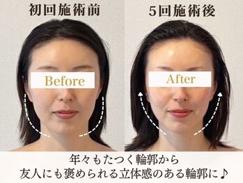 サロンキャン(Salon.CAN)/たるみ輪郭本格改善コース