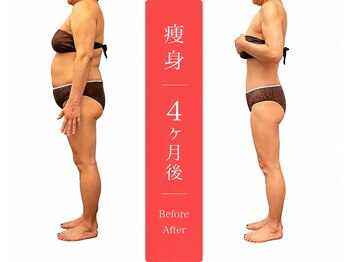 ムーン(MOON)/痩身全身before→after