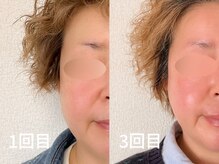 ルアナ(Luana)/1回～3回目の変化　小顔ヘッド
