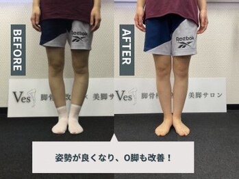 ビース(Ves)の写真/【新宿駅近】長年O脚・XO脚にお悩みのあなたに自信を持っておすすめ◎脚骨格改善専門サロンで本気のO脚改善