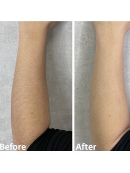 グロワール(gloire)/ひじ下脱毛