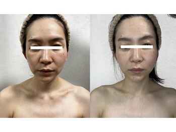 ソフィーム/エンビロンフェイシャル前後写真