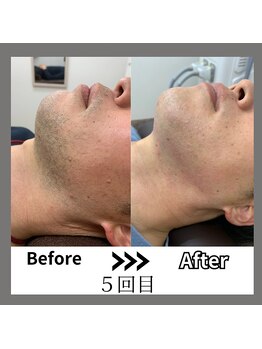 ミライキング(mirai king)/ビフォーアフター