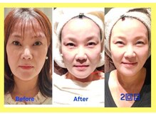 アン 銀座(ann)/レモンボトル&エクソソーム　