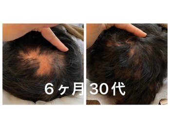 いいとこ鍼灸院の写真/【名古屋希少☆育毛促進鍼】抜け毛/細毛/前髪の後退など髪のお悩みに◎ボリューム&ハリコシのある髪に！