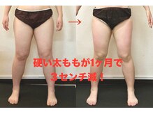 スマイルデイズ(Smiledays)/1ヶ月の入浴で、太ももに急変！