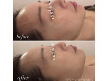 アンビエント(ambient)の雰囲気（ニキビ、肌荒れにはグリーンピール♪本物の肌質改善）