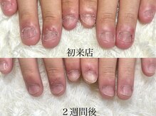 ココモ(cocomo)/深爪/自爪育成/フィルイン