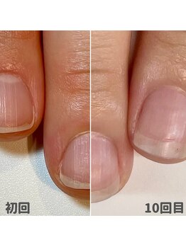 ココデネイル(cocode nail)/お悩み:横広くて小さい、深爪