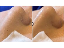 トータルビューティーサロン シフォン(Cfon)/鼻の黒ずみ徹底洗浄！