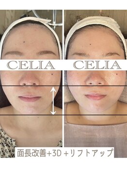 セリア(CELIA)/小顔矯正　