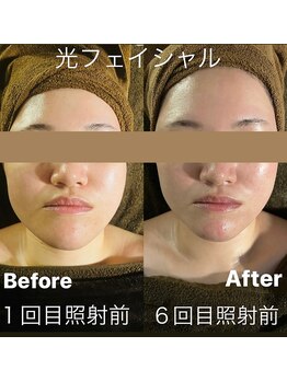 カヨン 新所沢店(KAYON)/小顔ケアと毛穴ケアを同時に