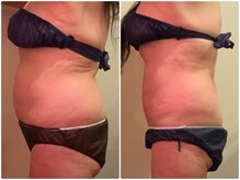 エステティックサロン アールグレー/「sogire」短期集中8回お腹