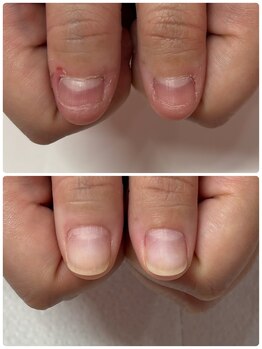 アトリエレポ/肌から変わる深爪矯正！