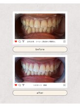 スマイルプライベートビューティサロン(Smile)/セルフホワイトニング