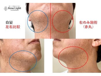 ヘルディン(heldin +555)/メンズ脱毛