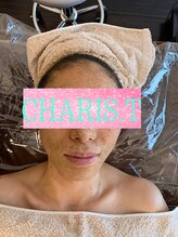 カリスティ(CHARIS.T)/グリーンハーブピーリング♪