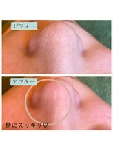 ランプ(Lampe)/◇ハイドラピーリングとプラズマ