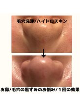 バリエステ シュクル/毛穴　黒ずみ　角質ケア