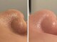 リジュベ(Rejuve)の写真/男女大歓迎！施術後の変化に大満足する方続出！頑固な毛穴悩みを徹底ケア！毛穴レスな卵肌に◎