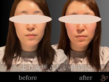 チョコバリ 郡山店(chocobari)/小顔×リフトアップ(美容鍼)20代