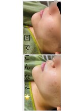 フォルチェ 神辺店(Folche)/小顔パート２！￥4400