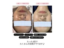 トータルビューティーサロン カノン(Kanon)/小顔コース×エイジングケア☆