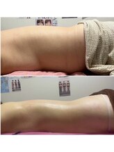 アプロディタ/背中の脂肪、疲れと共に流します