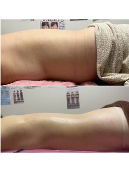 アプロディタ/背中の脂肪、疲れと共に流します