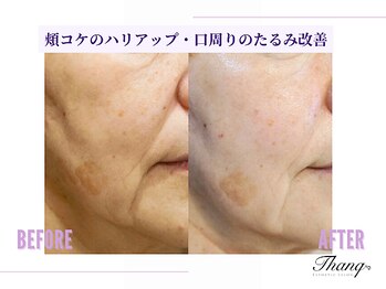 サンク(Thanq)/頬のこけもリフトアップで改善!