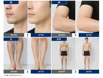 チュー 中目黒(chuu)の写真/【メンズ髭脱毛(鼻下、頬、顎、頬)初回¥2,500】ストレスない清潔感のあるお肌へ導きます♪