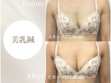 Onはり灸サロン/バストUP美乳鍼before→after