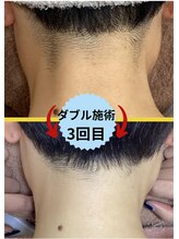 ディスイズミー シュガーリング(This is me Sugaring)/【ダブル】ショートの方オススメ