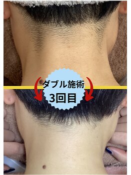 ディスイズミー シュガーリング(This is me Sugaring)/【ダブル】ショートの方オススメ