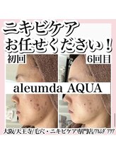 アルムダアクア 天王寺店(Aleumda AQUA)/ハーブピーリング/大阪/天王寺