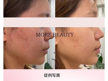 モアビューティー 庚午店(MORE BEAUTY)/症例写真
