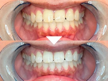 ビースト 下北沢店(B-st.)/セルフホワイトニング｜40分照射