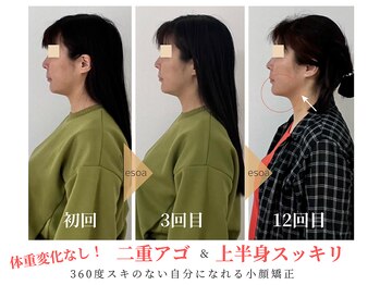 エソア(esoa)/小顔矯正×光フォト