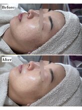 ソワナ(soina)/【神楽坂駅/フェイシャル/毛穴】