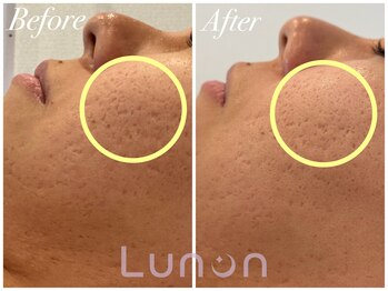 ルノン(Lunon)/毛穴洗浄ハイドロ×ララピール