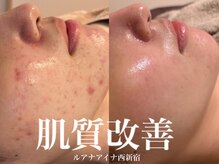 ルアナアイナ(Luana Aina)