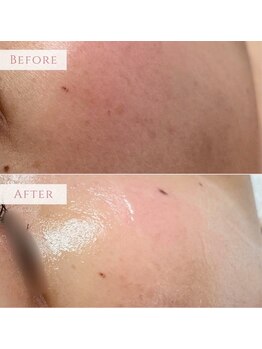 ハナハナ(hanahana)/赤みも灰色っぽさもあるお肌