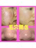 お悩みの方限定!【毛穴の開き】肌診断機付★オーダーメイドフェイシャル45分